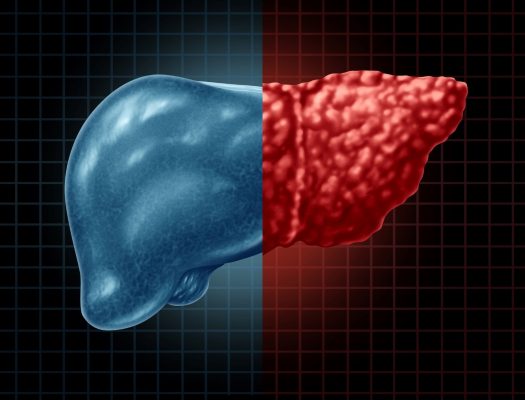 Are Glycemic Measures in the Nondiabetic Range Linked to NAFLD ...